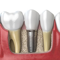 a 3D example of a dental implant in the jawbone