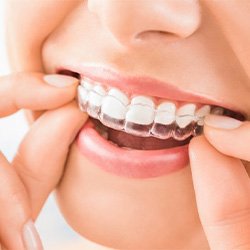 Lady places Invisalign aligners on teeth