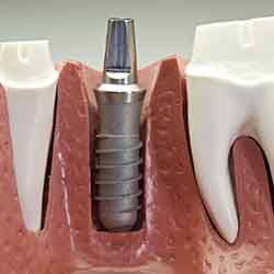 Model of an implant post replacing a tooth root