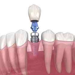 Model showing each part of a dental implant