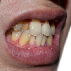 Invisalign patient in Toledo with a crossbite