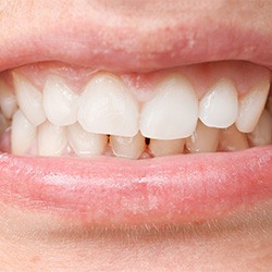 Invisalign patient in Toledo with an overbite