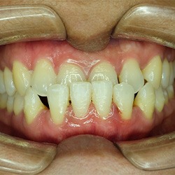 Invisalign patient in Toledo with an underbite