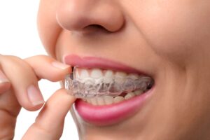 Nose-to-chin closeup of a woman inserting Invisalign on upper arch